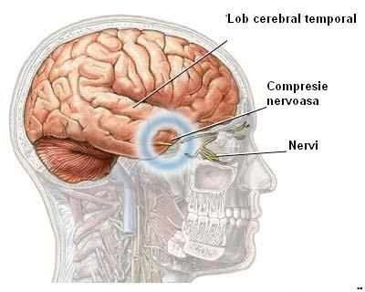 Hipertensiune intracraniana